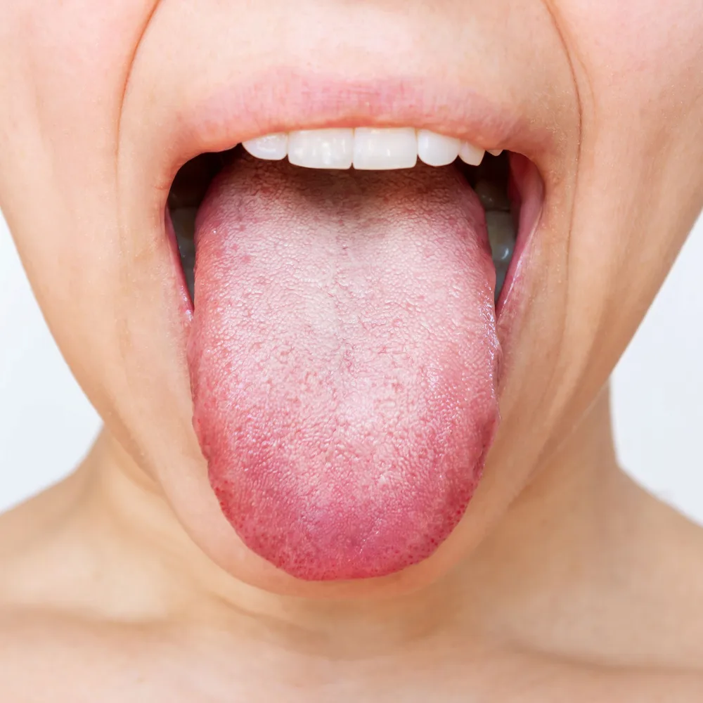 Candida Enfeksiyonu Nedir?
